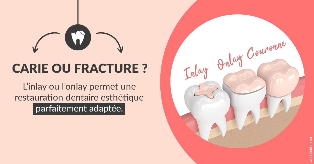 https://www.mysmile-orthodontics.com/T2 2023 - Carie ou fracture 2