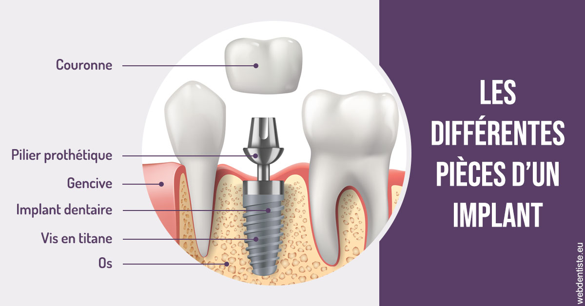 https://www.mysmile-orthodontics.com/Les différentes pièces d’un implant 2