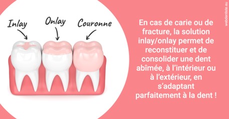 https://www.mysmile-orthodontics.com/L'INLAY ou l'ONLAY 2