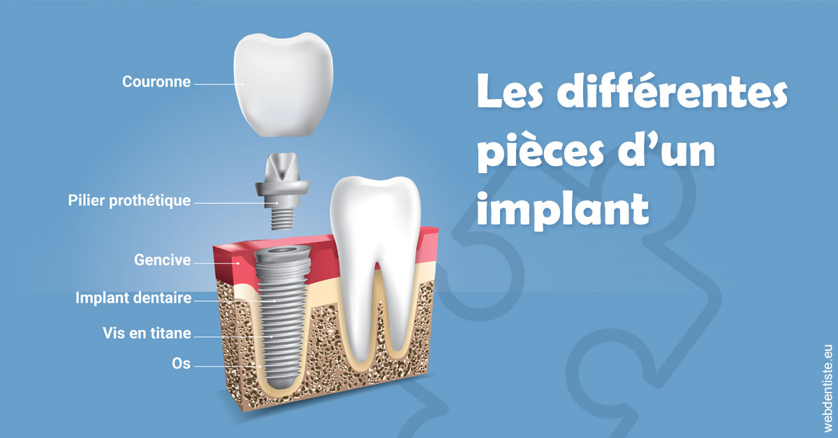 https://www.mysmile-orthodontics.com/Les différentes pièces d’un implant 1